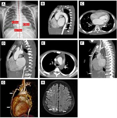 Case report: Aggressive progression of acute heart failure due to juvenile tuberculosis-associated Takayasu arteritis with aortic stenosis and thrombosis